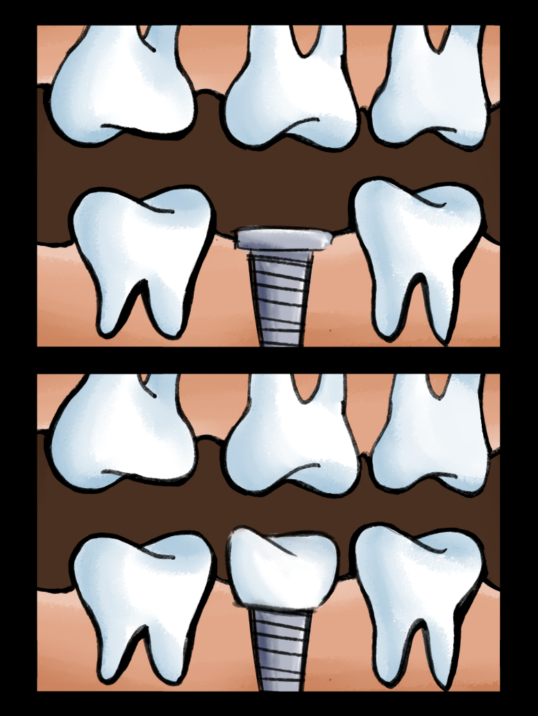 Dental Implants in Flushing, Queens NY