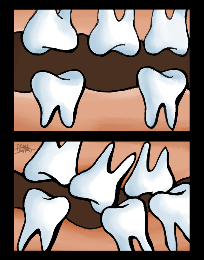 Dental Implants for Missing Teeth in Flushing, Queens NY
